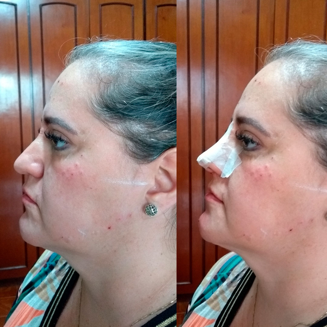 Rinomodelação Pressurizada